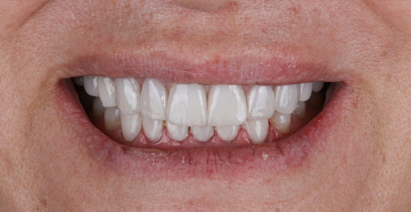 After treatment – Demo Invisalign® case 1