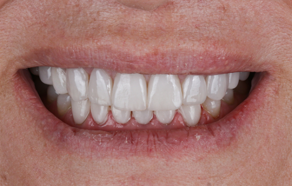 After treatment – Demo Invisalign® case 2