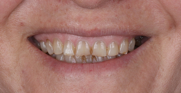 Before treatment – Demo Invisalign® case 1