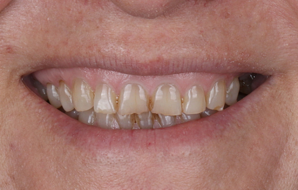 Before treatment – Demo Invisalign® case 2