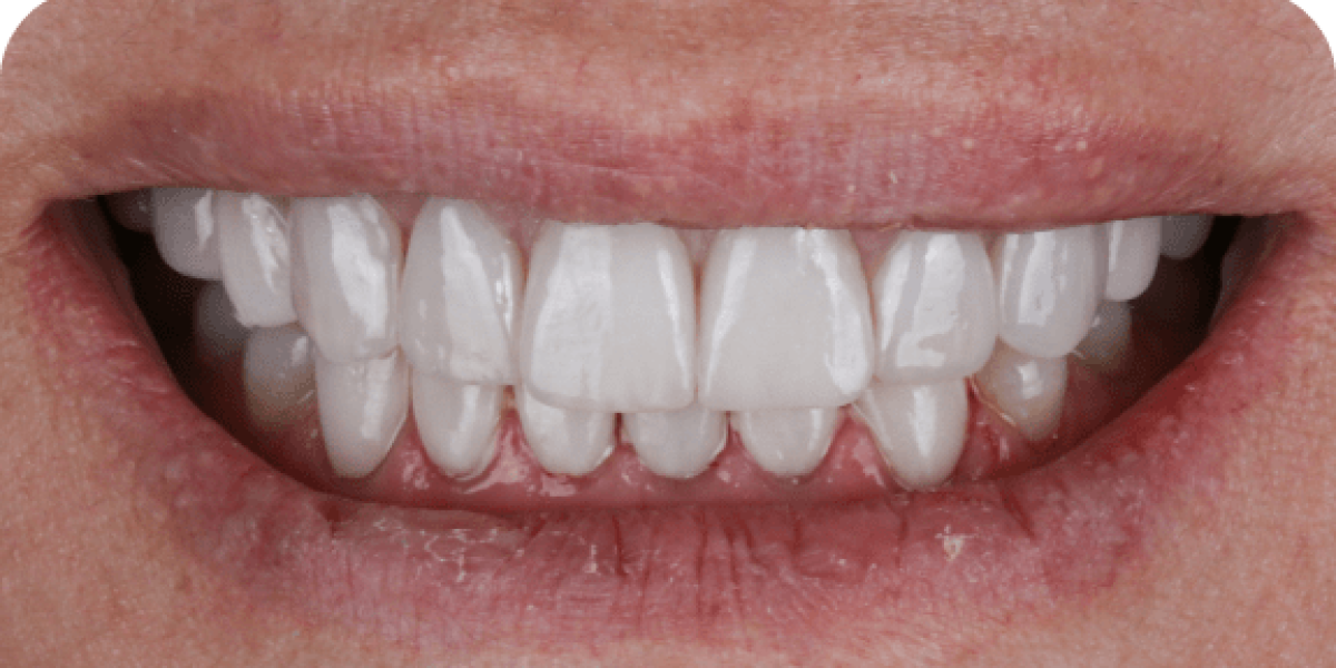 After treatment – Smile makeover 3