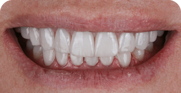 After treatment – Smile makeover 3