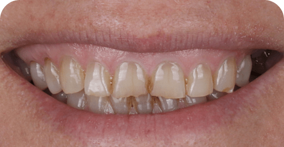 Before treatment – Smile makeover 3